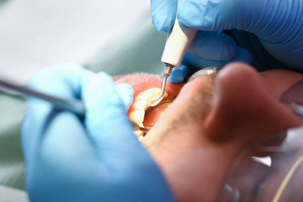 Best Knocked-Out Tooth (Avulsed Tooth) Treatment in Brinkley, AR