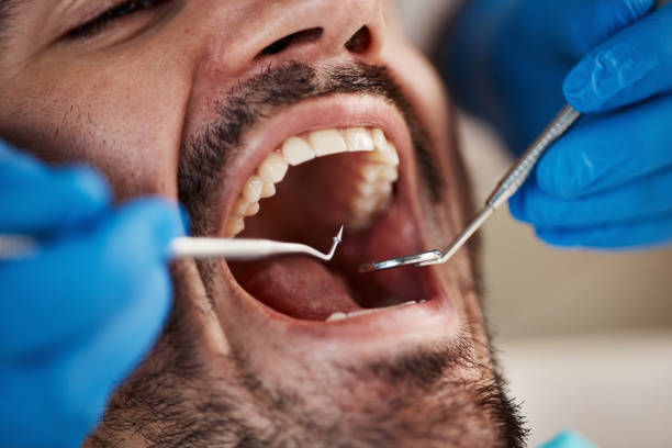 Best Emergency Wisdom Tooth Extraction in Brinkley, AR